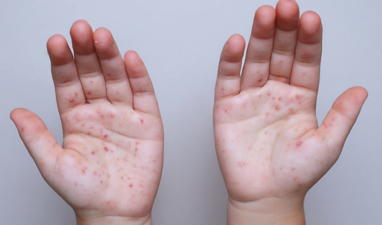 Panamá refuerza vigilancia y vacunación ante repunte de sarampión